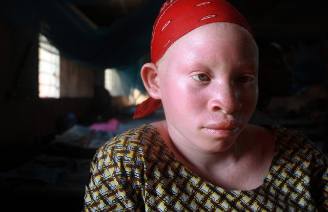 albinism in humans. after albinos were being